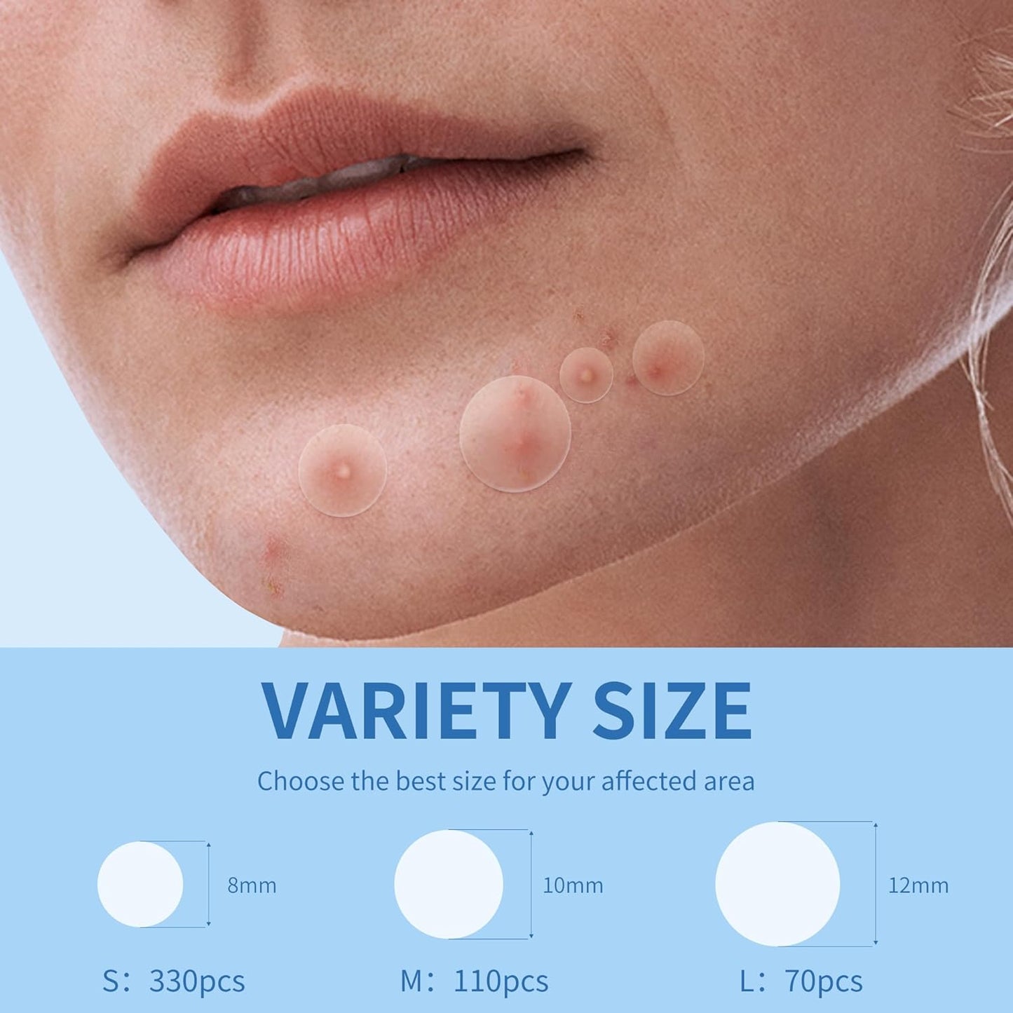Large Hydrocolloid Acne Patches | 400 Count | Effective Zit Treatment