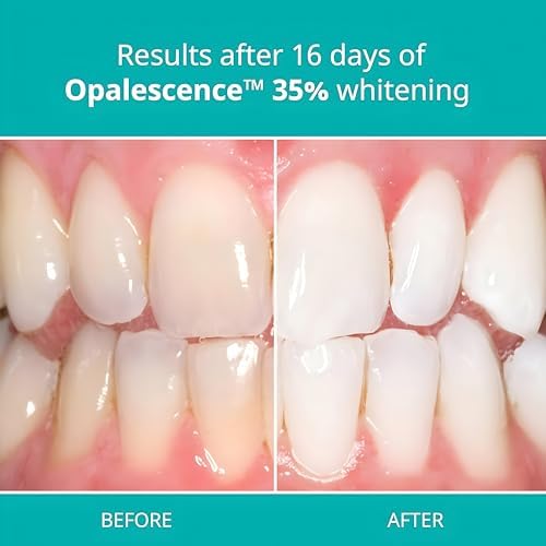 Opalescence 35% Gel Syringes Teeth Whitening - Refill Kit (2 Pack / 4 Syringes Total) Carbamide Peroxide. Made by Ultradent, in Melon Flavor. Tooth Whitening Refill Syringes 5404-1