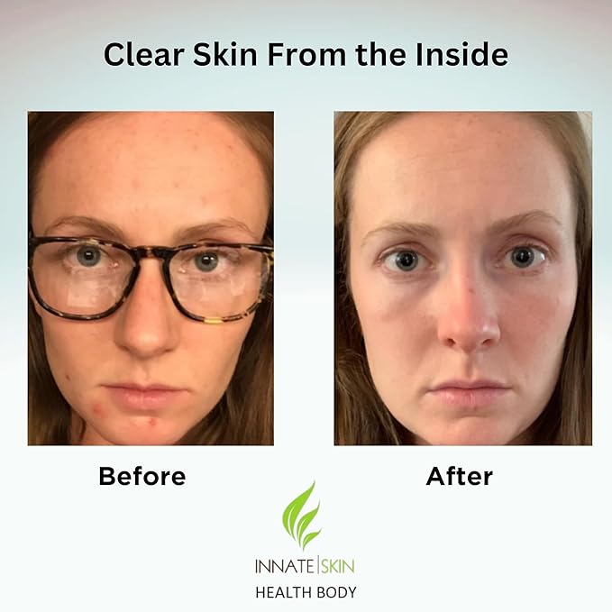 Clear Skin Acne Vitamin System | 20 Antioxidants, Botanicals & Minerals | 60 Count Pack of 2