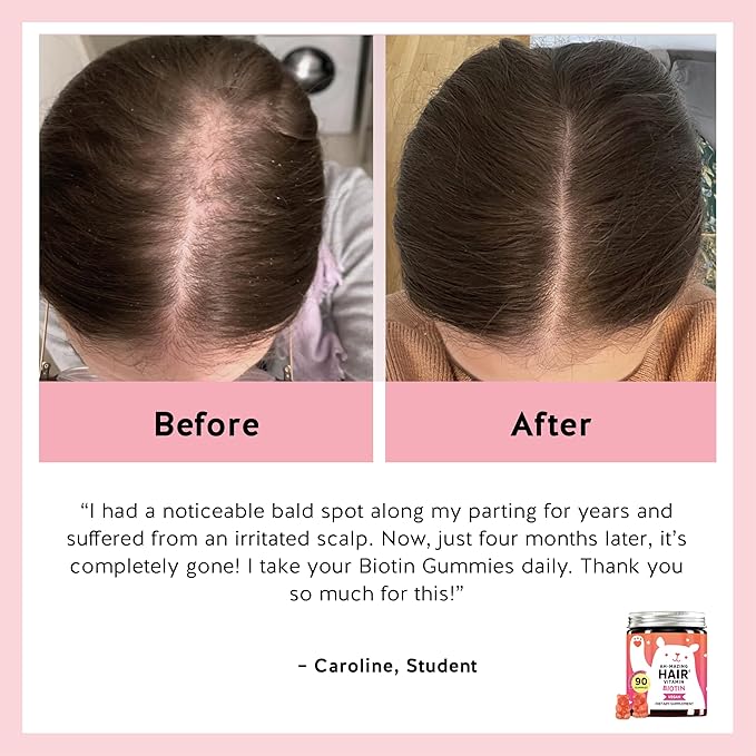 Biotin Gummies for Hair, Skin & Nails. 5,000 mcg High Potency Vegan Vitamins for Faster Hair Growth, Stronger Nails & Healthy Skin. with Vitamins C & E, 30 Gummies