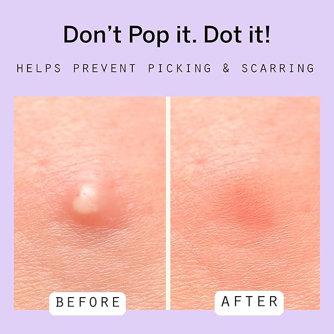 Dot Pimple Zit Patches for Face – Dermatologist Recommended & Ranked 1 for Most Effective Blemish Support – All Natural Hydrocolloid Acne Stickers with Vitamin C & Salicylic Acid (10 mm, 120 ct)