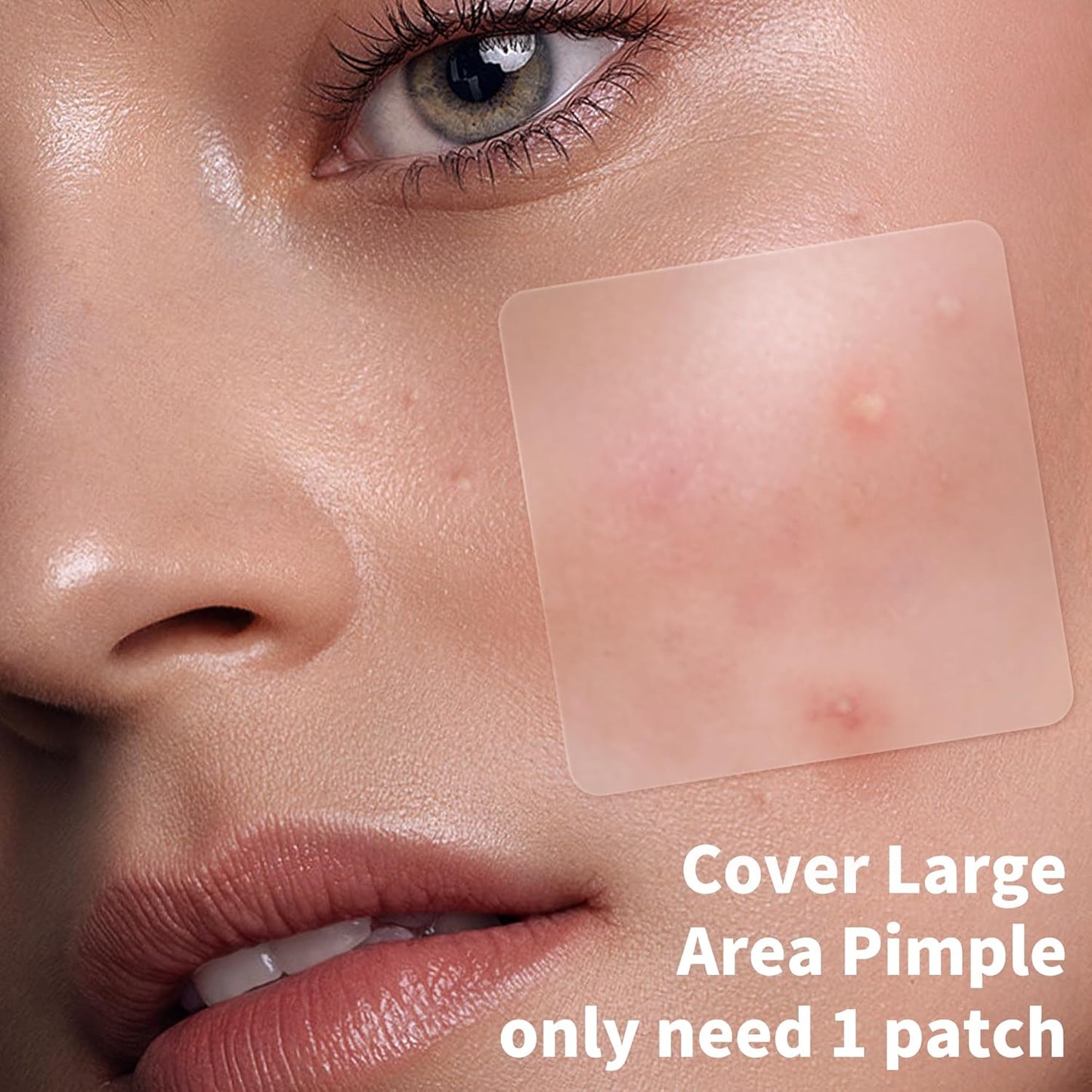 Large Hydrocolloid Acne Patches | 400 Count | Effective Zit Treatment